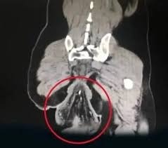 Homem sofre prolapso retal após usar celular no vaso