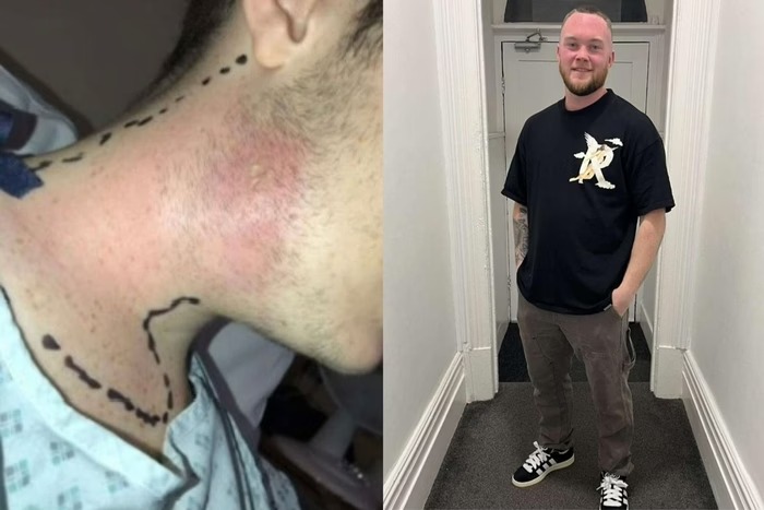 Jovem quase morre após espremer espinha no pescoço