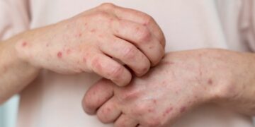 Minas Gerais confirma cinco casos de mpox em 2026